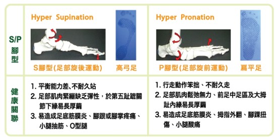 S/P腳型理論比較圖：過度旋後S型腳（高弓足）與過度旋前P型腳（扁平足）