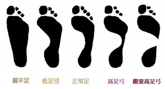 五種常見足型分類特徵圖：扁平足、低足弓、正常足、高足弓、嚴重高足弓