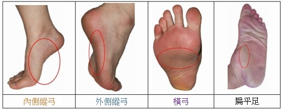 扁平足與正常足弓構造對比:內側縱弓、外側縱弓及橫弓分布圖