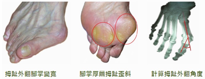 大拇趾外翻外觀導致腳掌變寬、腳底長厚繭與角度歪斜對比圖