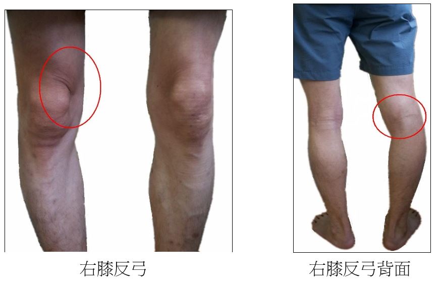 右膝反弓與膝蓋過度後鎖正面背面外觀圖