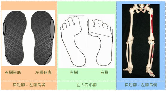 透過鞋底磨損比例與日常步態判讀代償性長短腿與大小腳關聯