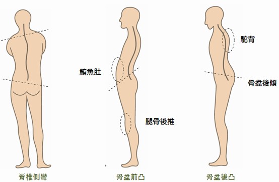 足弓與骨盆不平衡引發的脊椎側彎、鮪魚肚骨盆前傾、駝背骨盆後傾體態圖