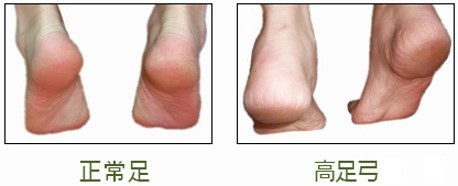 正常足與高弓足顛腳時的弧度對比圖